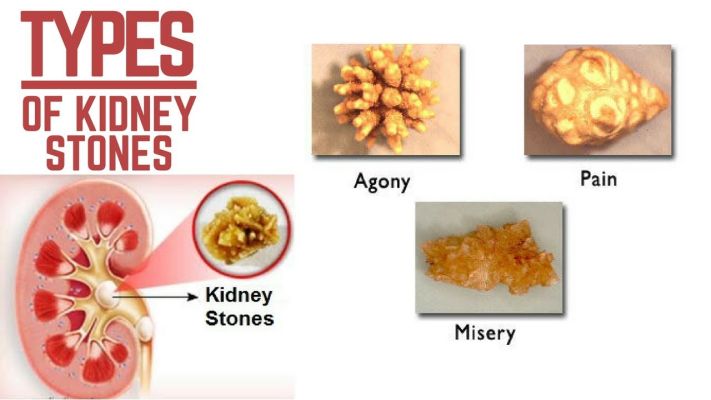 Kidney Stones Types Causes And Complications Dr Shailendra Goel